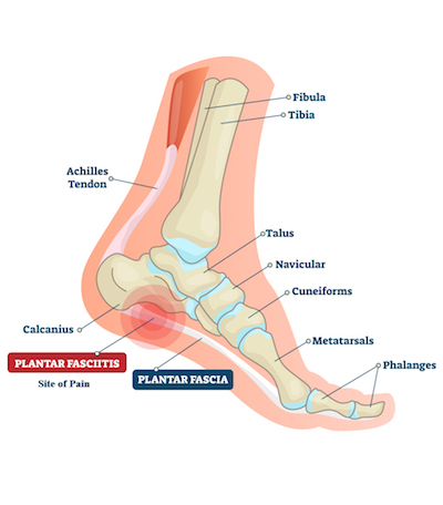 foot inflammation plantar fasciitis