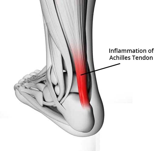 achilles tendon pain after sprained ankle