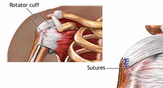 Rotator Cuff Repair Breakthrough with CuffMend!: Advantage Orthopedics:  Orthopedic Shoulder Surgeons