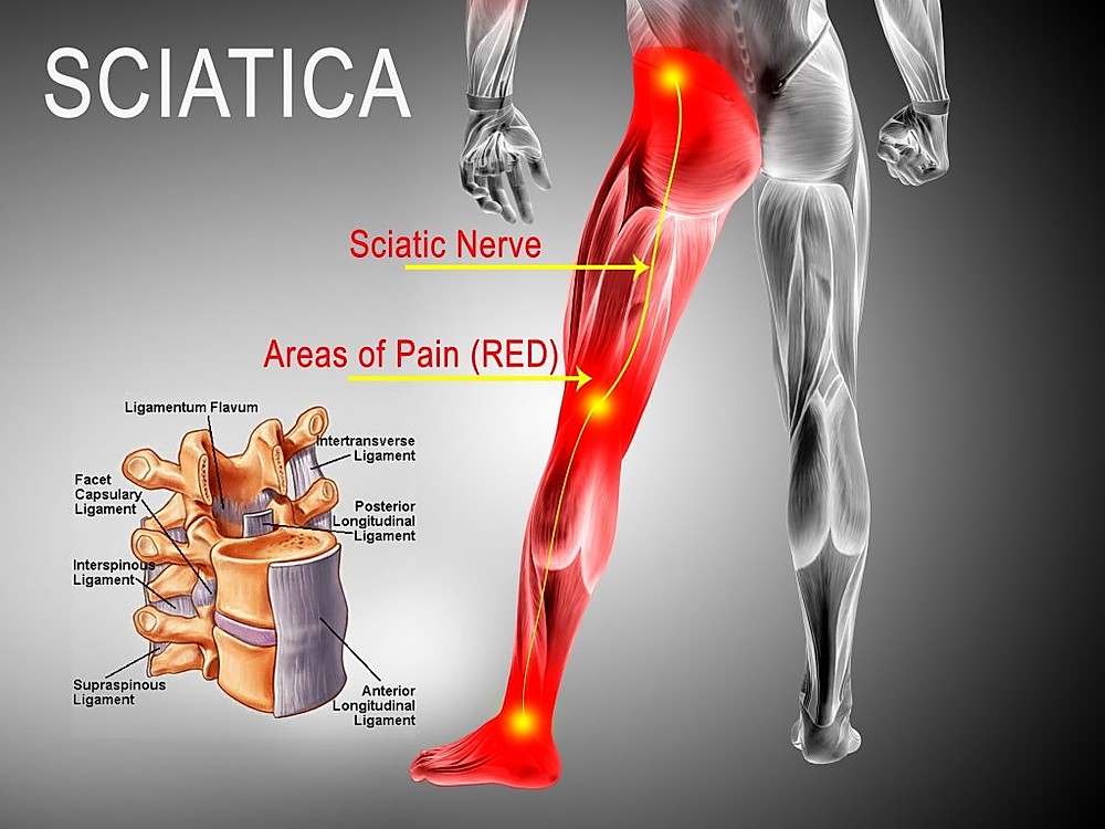 Sciatica Pain Treatments Brisane - Resolve shooting leg pain fast at Knead