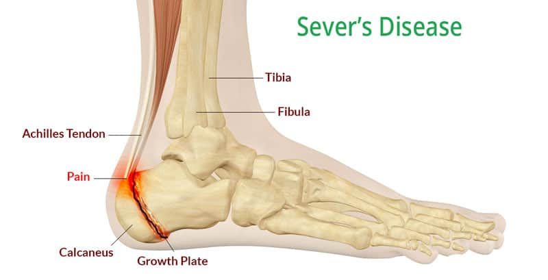 heel and knee pain
