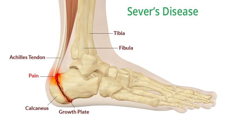 Back of store ankle pain