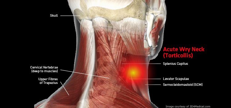 Stiff Neck Torticollis Back In Action