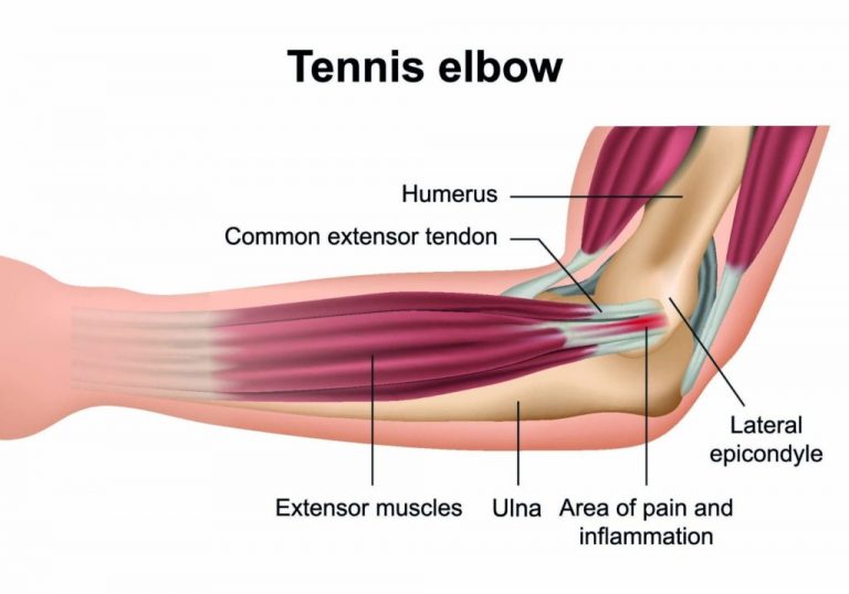 tennis-elbow-back-in-action