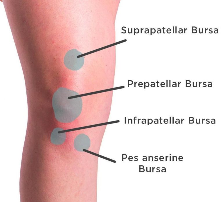 knee-bursitis-skin-pic-back-in-action